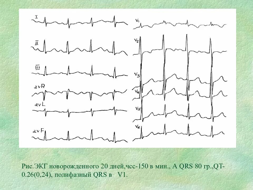 ЭКГ У грудничка норма. ЭКГ У новорожденного правограмма. ЭКГ здорового ребенка 1 год. ЭКГ здорового новорожденного. Экг со скольки