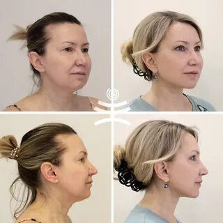 Эндоскопическая подтяжка лица