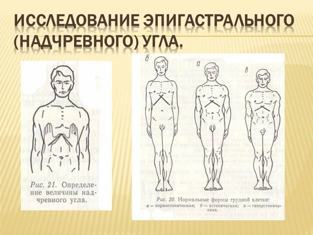 Грудная клетка у ребенка норма. Эпигастральный угол. Типы телосложения. Тип телосложения по эпигастральному углу. Астеническое Телосложение эпигастральный угол.