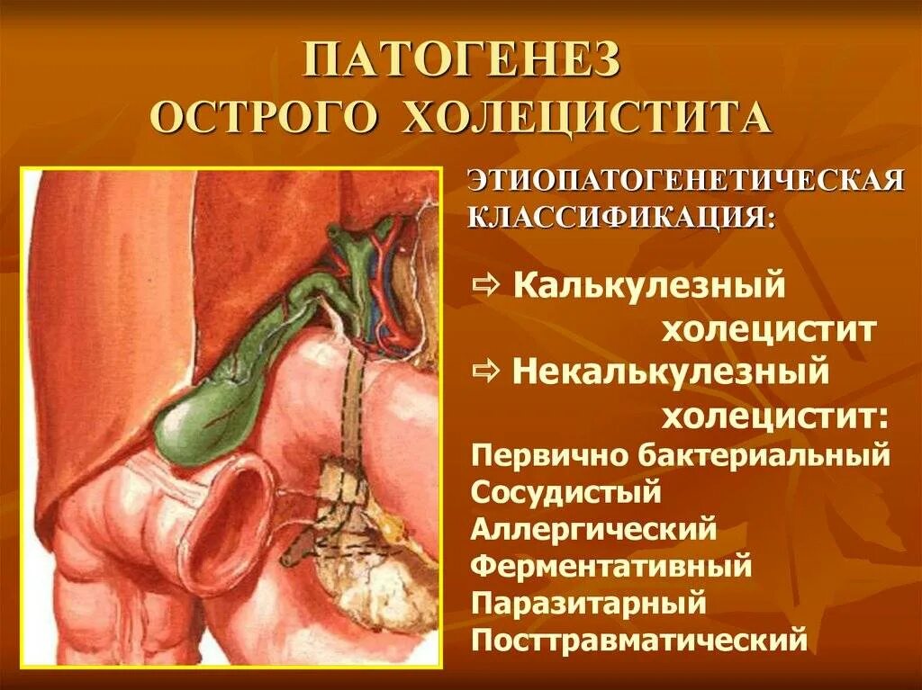 Острый холецистит Факультетская хирургия. Острый калькулезный холецистит этиология. ЖКБ, флегмонозный калькулезный холецистит. Острый бескаменный катаральный холецистит.