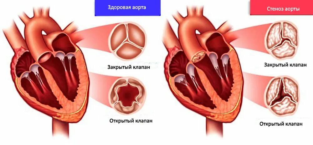 Аортальный стеноз что это такое. Стеноз аортального клапана клапан. Аортальный стеноз (сужение отверстия аорты);. Двухстворчатый клапан аорты стеноз. Стеноз двустворчатого аортального клапана.