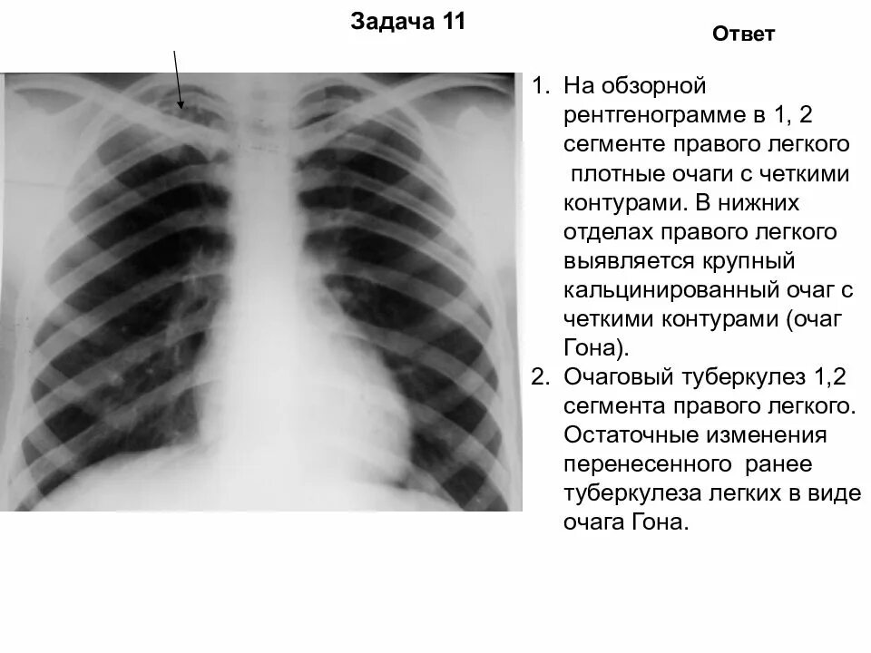 Тень в верхней доле. Очаг уплотнения s6 правого легкого. Очаговый туберкулез s1+2 правого легкого. Очаг гона s3 левого легкого.. Первичный туберкулезный комплекс рентген.