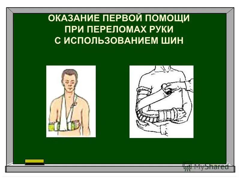 алгоритм оказания первой помощи при переломах рук. оказание пмп при переломах конечностей. оказание 1 помощи при переломе руки. оказание 1 помощи при переломе руки. алгоритм оказания первой помощи переломы конечностей.