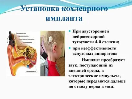 Слуховые аппараты 4 степень