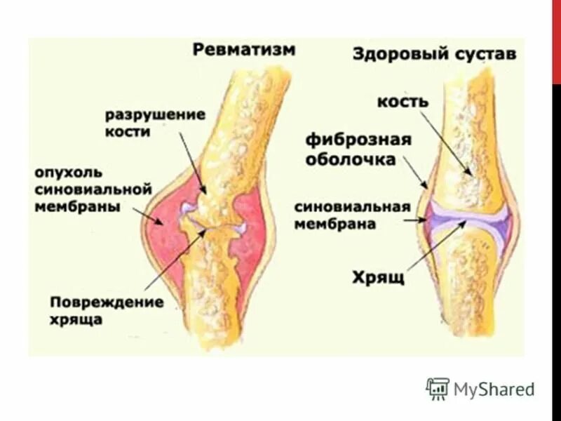 Болезнь суставов у взрослых. Ревматизм у детей симптомы. Ревматизм суставов у детей.