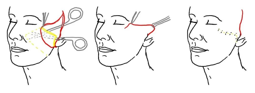 Смас лифтинг схема операции. Эндоскопический височный лифтинг схема операции. Эндоскопический височный лифтинг схема. Схема подтяжки лица