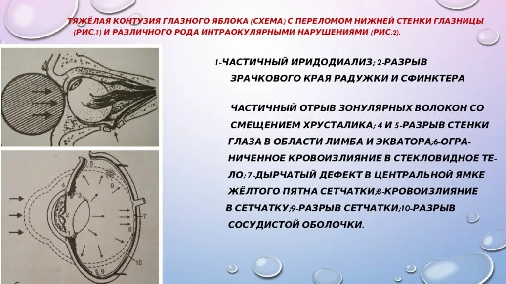 Что такое контузия словами и последствия. Контузия глазного яблока. Осложнения контузии глаза. Контузия глазного яблока классификация. Контузия глазного яблока тяжелой степени.