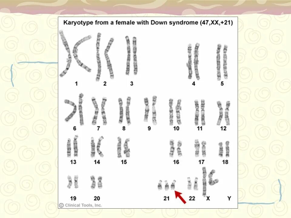 Количество хромосом в кариотипе человека. Кариограмма синдрома Эдвардса. Синдром Патау (трисомия 13-й хромосомы). Нормальный кариотип человека 46 хромосом. Синдром Дауна кариотип схема.