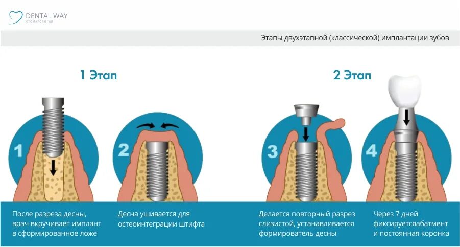 Алгоритм работы кортикального импланта. Одномоментная имплантация двухэтапная. одноэтапная имплантация. одномоментная имплантация зубов этапы. одноэтапная имплантация зубов.
