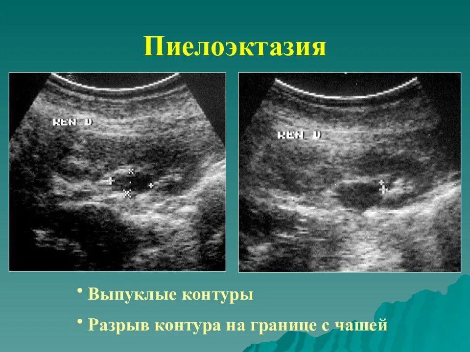 Увеличение лоханок у детей