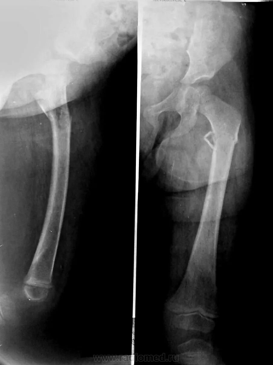 Сколько заживает бедро. Диафизарный перелом бедренной кости рентген. Перелом диафиза бедренной кости. Перелом диафиза бедренной кости рентген. Перелом бедренной кости в средней трети диафиза.