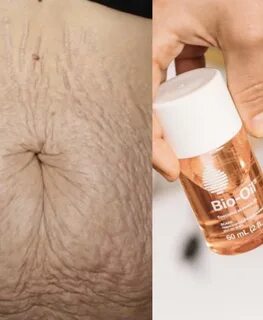 Does Bio oil clear stretch marks ? 