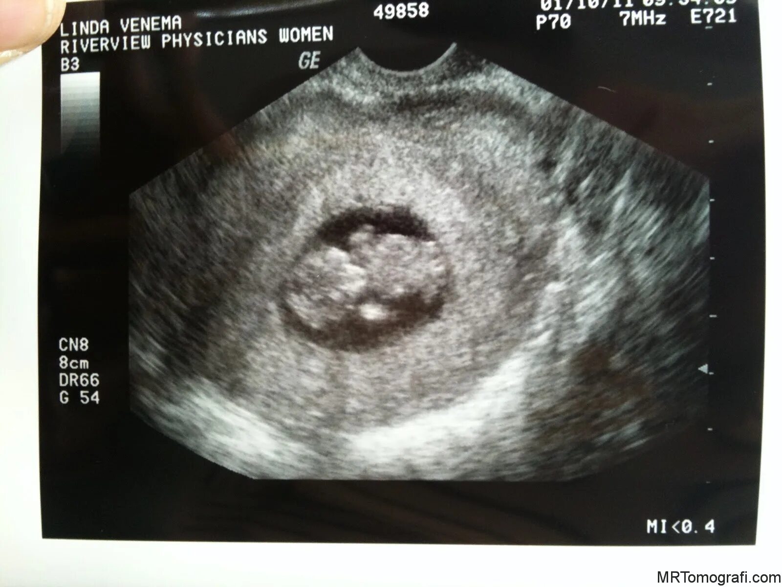 8 недель и 4 дня. Снимок УЗИ 9 недель беременности эмбрион. 10 Недель беременности фото УЗИ ребенка. Снимок УЗИ на 10 неделе беременности. УЗИ 9 недель беременности фото.
