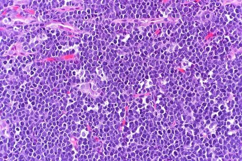 Lymphoma
