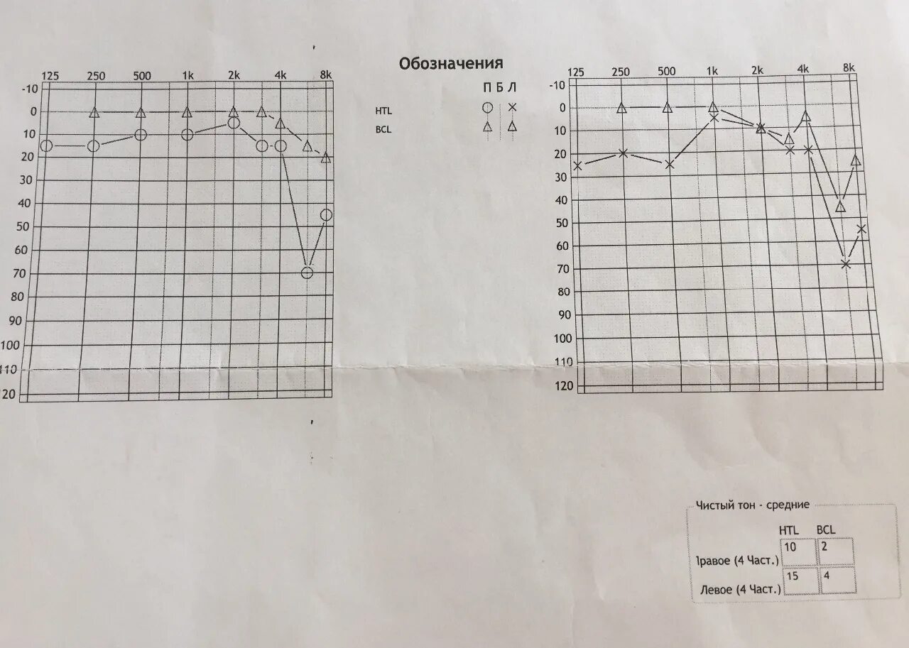 Сенсоневральная тугоухость аудиограмма. Кондуктивная тугоухость аудиометрия. Тональная пороговая аудиограмма норма. Аудиограмма слуха норма. Аудиограмма в спб