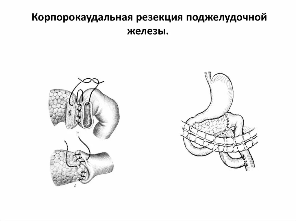 Дистальная резекция поджелудочной железы. Операция Бегера на поджелудочной железе схема. Дистальная субтотальная резекция поджелудочной железы. Резекция головки поджелудочной железы схема.