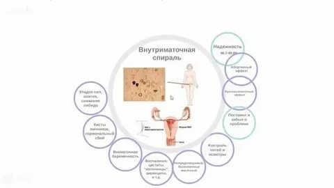 Кайлина спираль побочные эффекты
