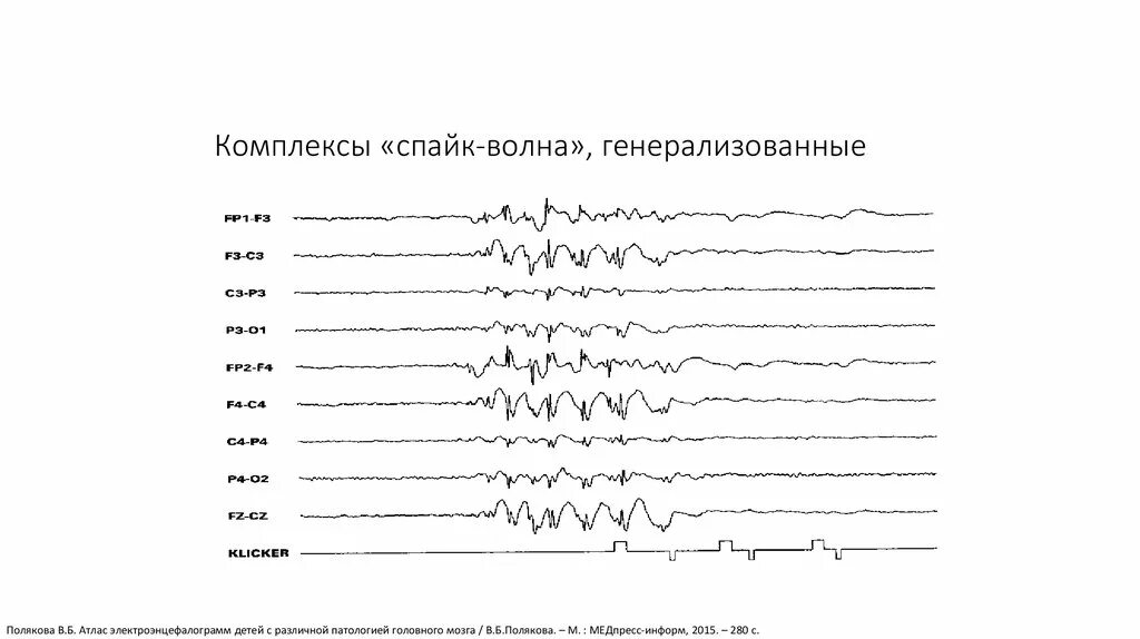 Генерализованная Спайк волна на ЭЭГ. Спайк медленная волна на ЭЭГ что это. Генерализованные комплексы пик волна на ЭЭГ. Спайк комплексы на ЭЭГ. Спайк на ээг