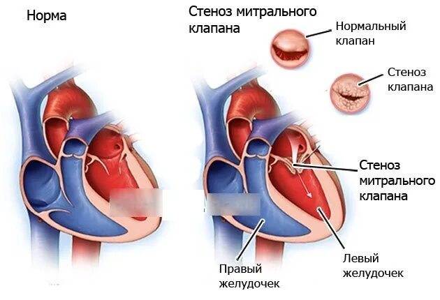 Митральный аортальный стеноз. Аортальный и митральный стеноз. Стеноз и недостаточность митрального клапана. Стеноз митрального клапана гемодинамика. Стеноз митрального клапана симптомы.