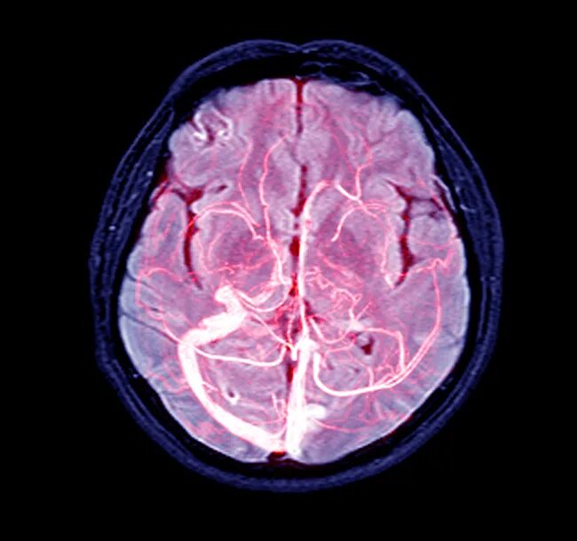 Венография головного мозга. Магнитно-резонансная венография головного мозга. Кт головного мозга и сосудов. Ангиография и венография головного мозга что это. Венография головного мозга с контрастом.
