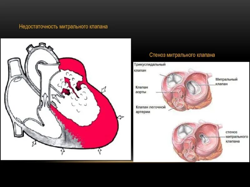 Стеноз аортального митрального клапана. Стеноз митрального клапана рисунок. Врождённый порок сердца аортальная недостаточность. Кальциноз аортальный клапан сердца. Функциональные шумы при аортальной недостаточности.