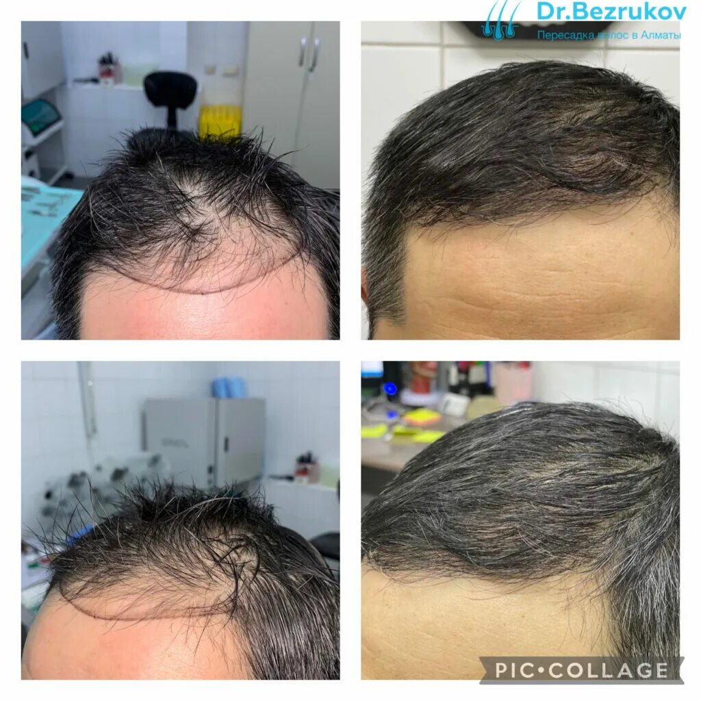Трансплантация волос до и после.