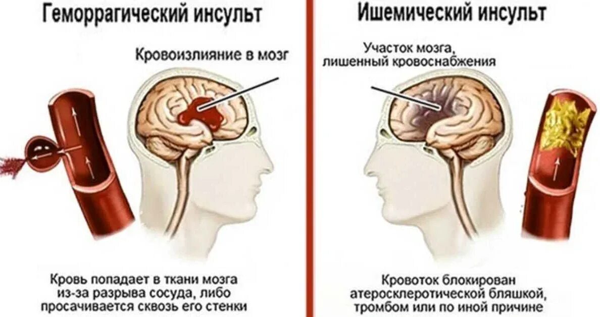 Микроинсульт что делать. Симптомы геморрагического и ишемического инсульта. Причины геморрагического инсульта головного мозга. ОНМК геморрагический инсульт симптомы. Ишемический инсульт Возраст больных.