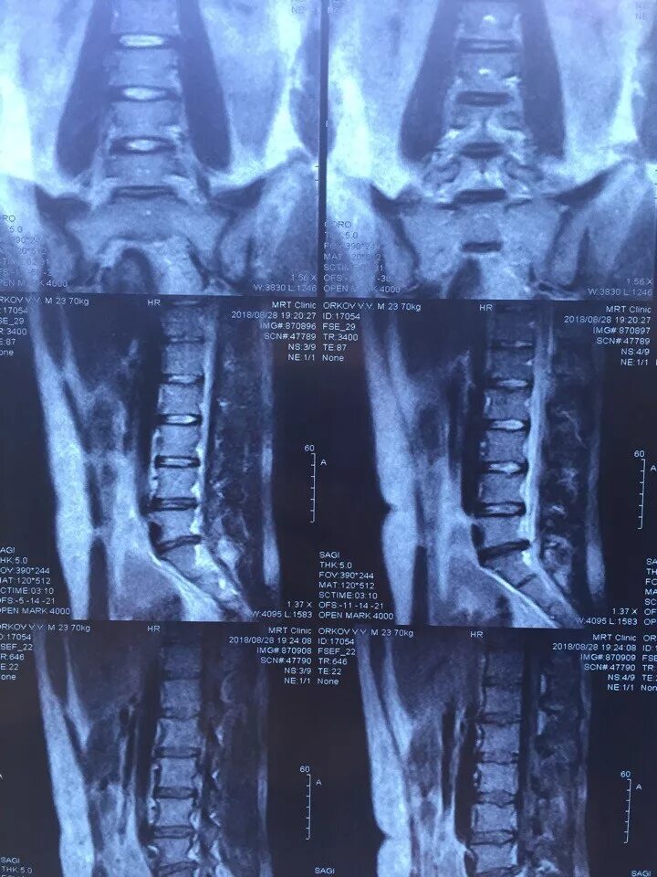 Грыжи поясничного отдела позвоночника у женщин. Мрт крестцово поясничного отдела грыжа. Снимок мрт поясничного отдела грыжа. Междисковая грыжа поясничного отдела симптомы. Грыжа на снимке мрт поясничного отдела.