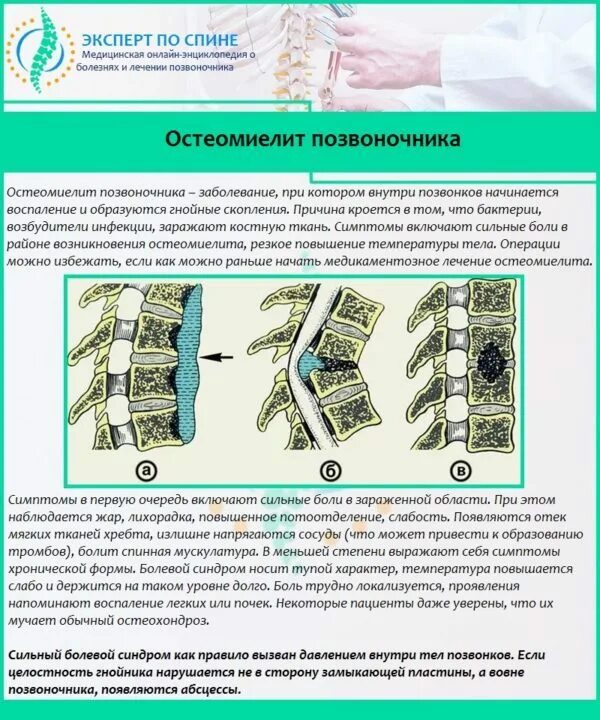 Рак позвоночника симптомы и признаки поясничного отдела. Остеомиелит позвонков. ткани позвоночника. остеомиелит поясничного отдела позвоночника. остеомиелит позвоночника симптомы.