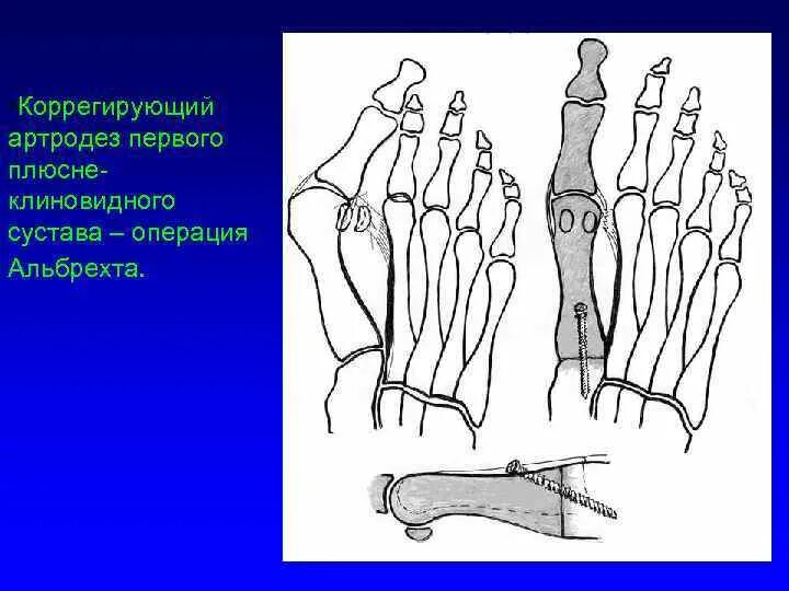 Операция шеде. Шевронная остеотомия 1 плюсневой кости. Операция шеде. Операция аддуктотомии при hallux valgus. Остеотомия при вальгусная деформация.