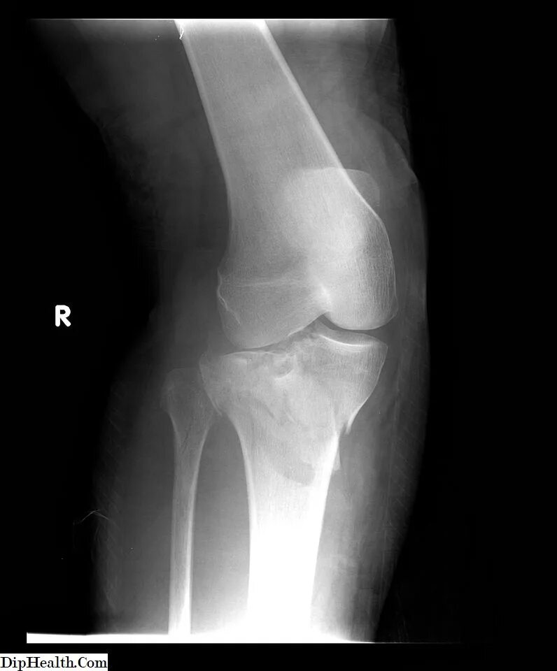 Перелом плато большеберцовой кости. Перелом большой берцовой кости в коленном суставе. Перелом малоберцовой кости. Перелом малоберцовой кости рентген.
