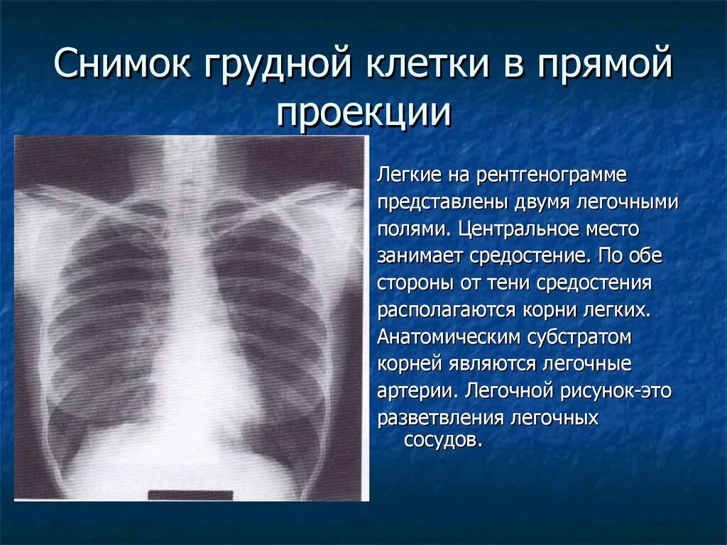 Перелом грудной клетки рентген. Передняя проекция грудной клетки рентген. Задняя проекция грудной клетки рентген. Рентгенография грудной клетки 2 проекции норма. Легкие в прямой проекции