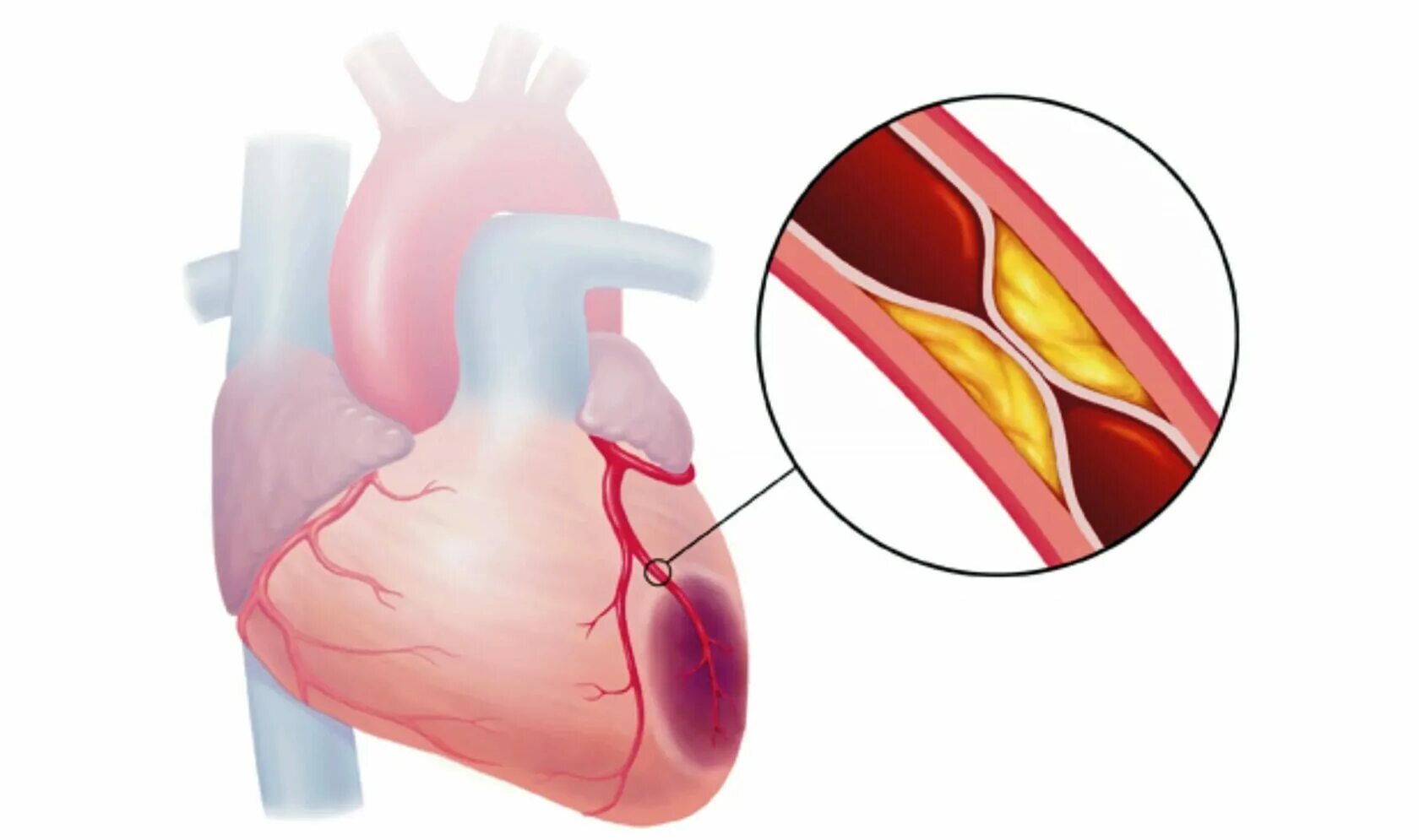 Коронарная ишемия. Ишемическая болезнь сердца стенокардия. 1.Ишемическая болезнь сердца. Коронарная недостаточность и ИБС. ИБС стенокардия инфаркт миокарда.