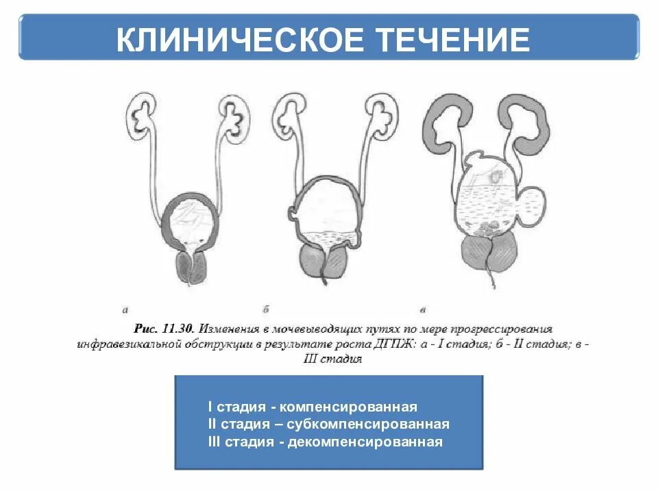 Стадии дгпж. Стадии гиперплазии предстательной железы. Клиническая классификация ДГПЖ. ДГПЖ предстательной железы что это такое.