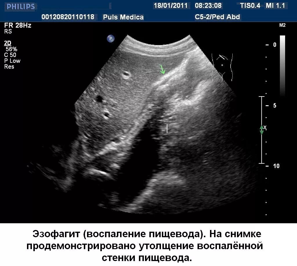 Узи брюшной полости узи пищевода. Узи органов брюшной полостиэ. Узи живота. Грыжа пищеводного отверстия диафрагмы на узи. Методика проведения узи.