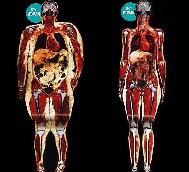 Скелет Толстого и худого человека. Рентген человека. Толстый человек рентген.