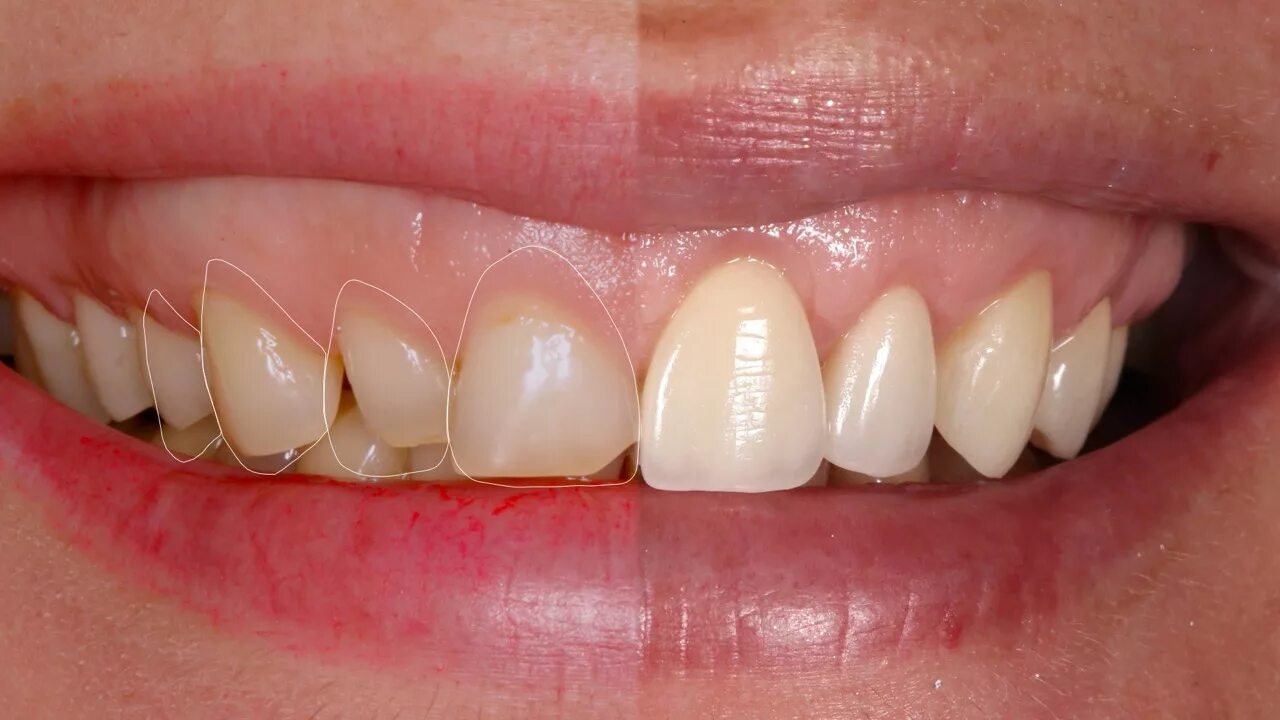 Винир прямой композитный. Винир прямой композитный