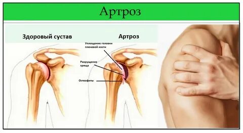 Препараты для лечения артроза плечевого сустава