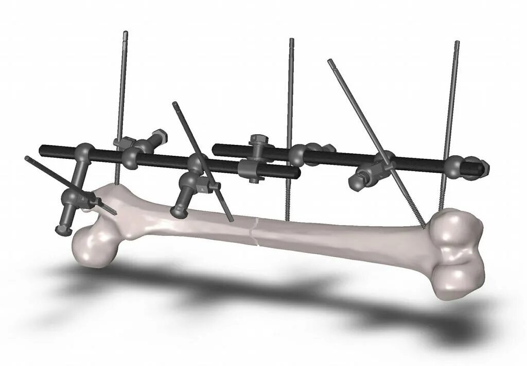 External development. External fixation systems i. declinatio iii medical.