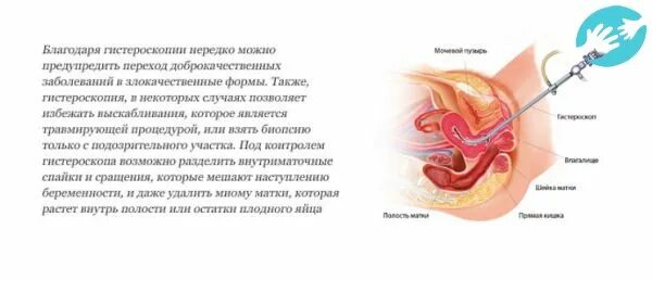 рекомендации врача после гистероскопии. анализы для гистероскопии. гистероскопия протокол операции. гистероскопия рекомендации после операции. заключение гистологии после выскабливания.
