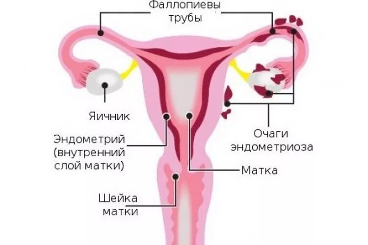 Фаллопиевы трубы это. Эндометриоз фаллопиевых труб. фаллопиевы трубы у женщин.