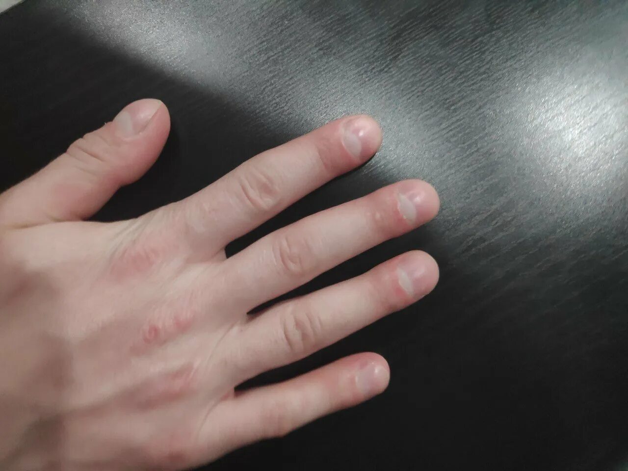 Пальцы барабанные палочки. Мужские пальцы. Синдром мари бамбергера. Округлые пальцы. Округлые пальцы.