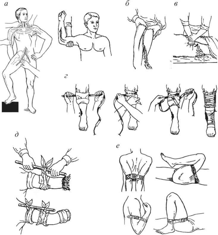 Пути остановки кровотечений. Способы временной остановки кровотечения наложение жгута. Методы остановки кровотечения схема. Схема остановки артериального кровотечения. Способы остановки кровотечения хирургия.