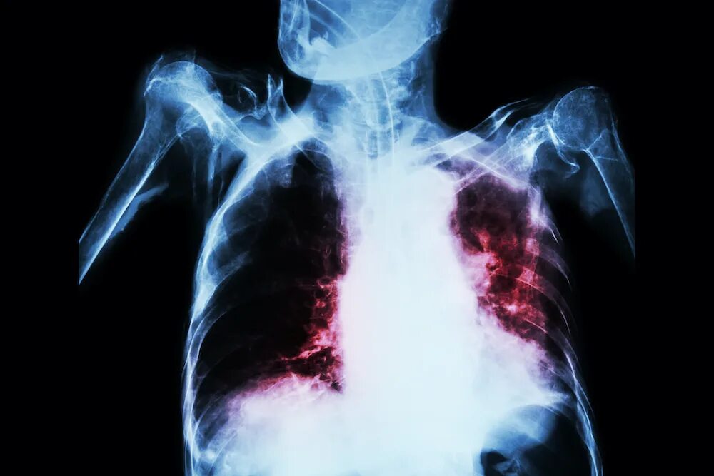 Легочное кровотечение туберкулез. Modern diseases. Иммунная система картинки. Modern diseases. Легочное кровотечение туберкулез.