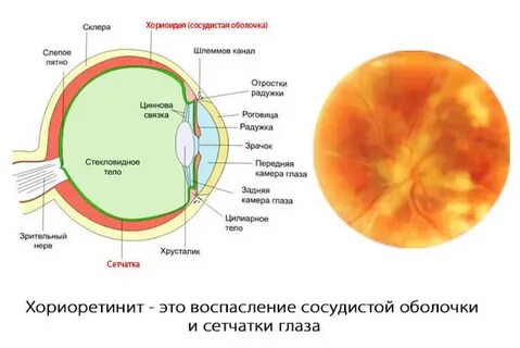 Хориоидея