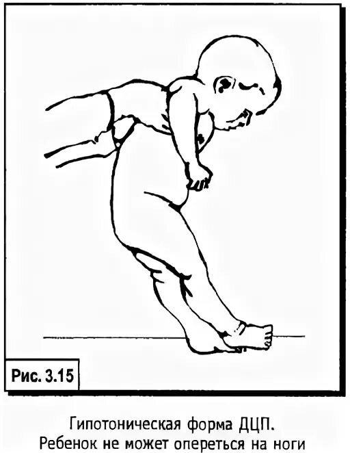 Дцп мозг. ДЦП гипотоническая форма. Гипотонически атактическая форма ДЦП. ДЦП легкая форма. Спастическая двусторонняя диплегия.