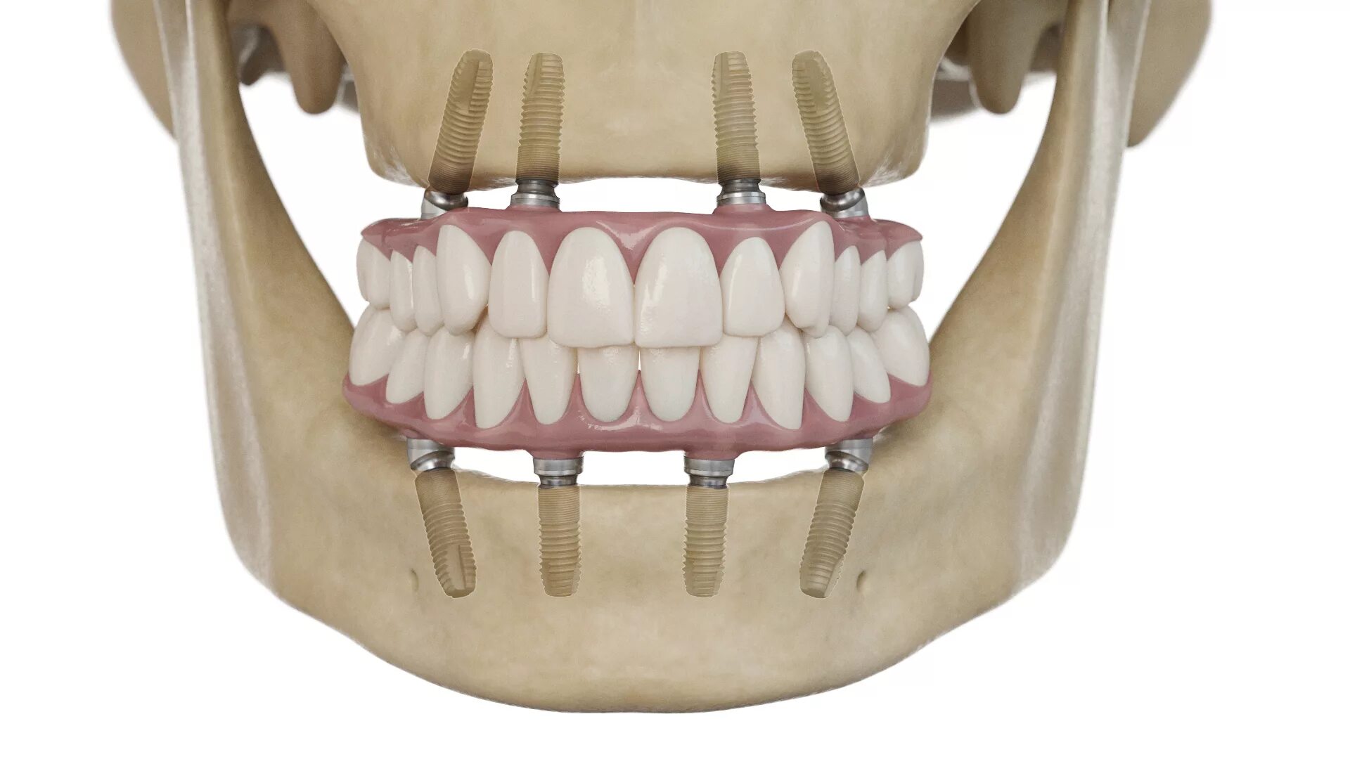 Несъемные зубные протезы на 4 имплантах. Имплантация all on 4 челюсть. Несъемный протез на 4 имплантах.