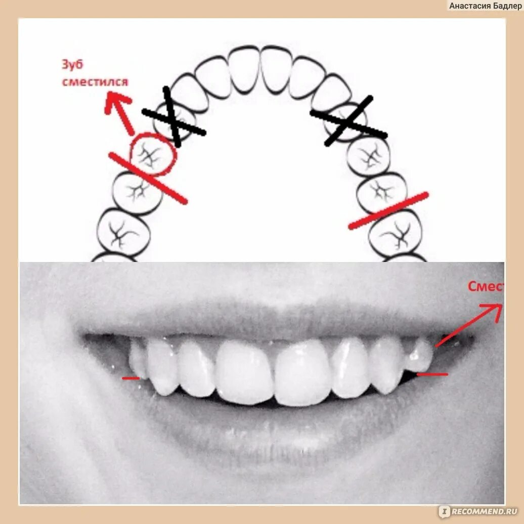 Виртуальное моделирование элайнеры. Зуб. Почему зубы двигаются. Почему зубы двигаются. Почему зубы двигаются.