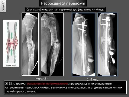 Несросшийся перелом