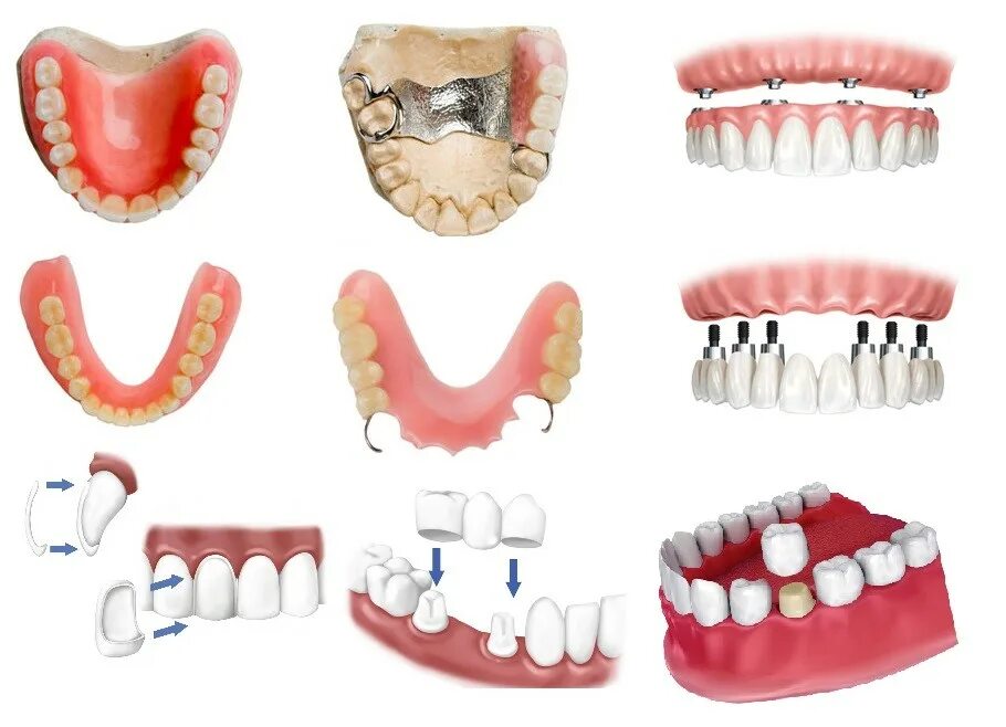Протезирование зубов виды